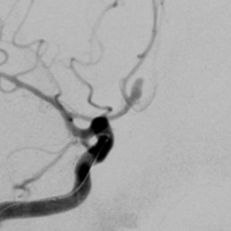 Saccular aneurysm