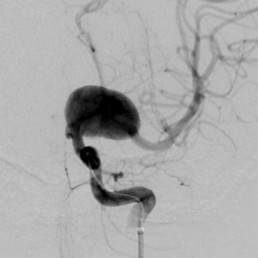 Fusiform aneurysm