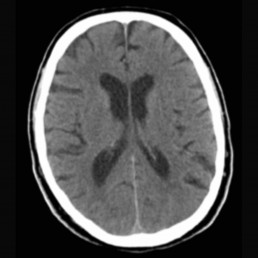 Normal CT head