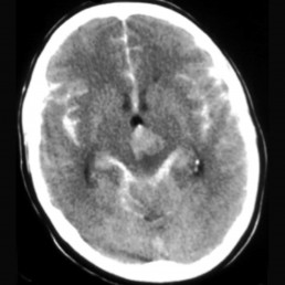 CT Head with extensive subarachnoid haemorrhage