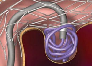 Stent coiling of an aneurysm