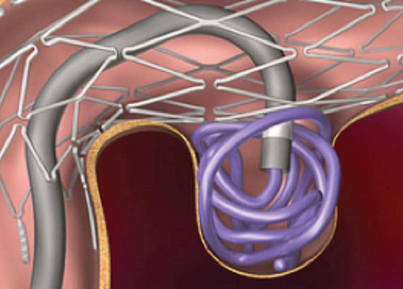 Brain Aneurysms Adam Rennie Consultant Interventional Neuroradiologist
