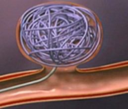Endovascular coiling of an aneurysm