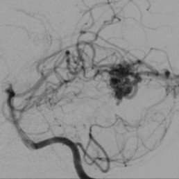 Arteriovenous Malformations