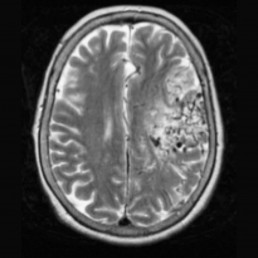 Arteriovenous Malformation presentation 1
