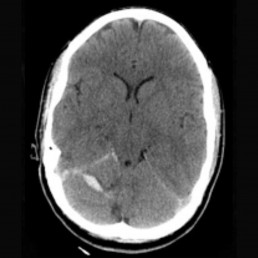Arteriovenous Malformation presentation 2
