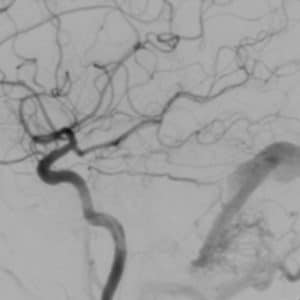 Brain Dural Arteriovenous Fistula