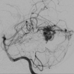 Paediatric Arteriovenous Malformation