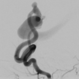 Paediatric Pial Arteriovenous Fistula