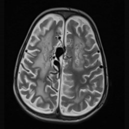 Paediatric Pial Arteriovenous Fistula