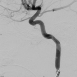 Intra-arterial Chemotherapy for Retinoblastoma