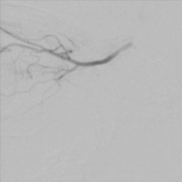 Intra-arterial Chemotherapy for Retinoblastoma